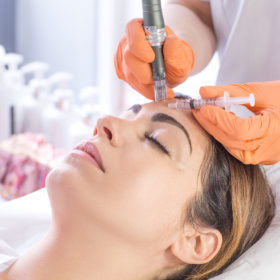 microneedling genève
